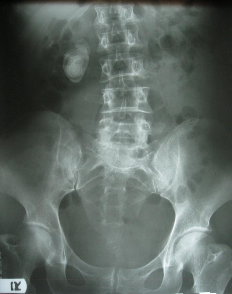 Grab Xray For Kidney Stone You Should Know