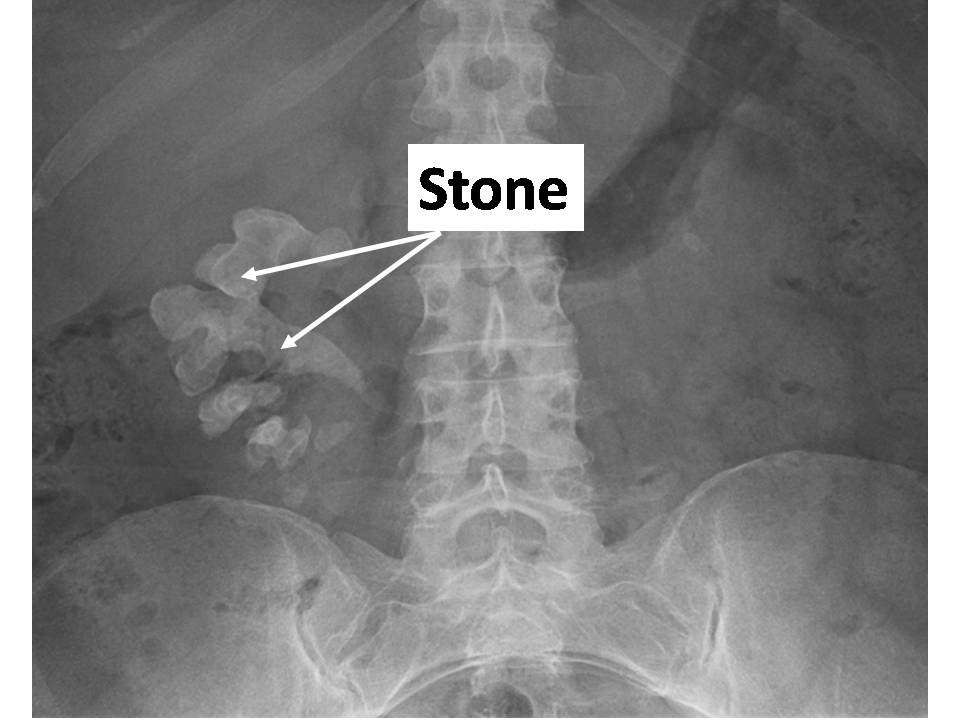 HEALTH FROM TRUSTED SOURCES: Kidney stones