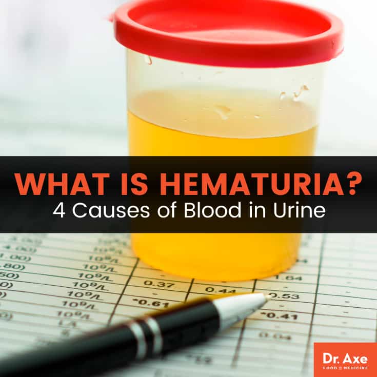 Hematuria: What Causes Blood in Urine?