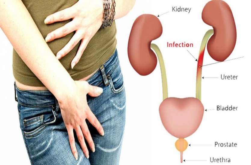 Holding Urine For A Long Time Can Be A Cause Of Kidney Stones Others ...