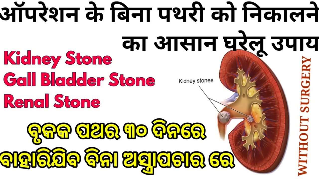Home remedies for Kidney stone, Gall Bladder stone,Renal ...