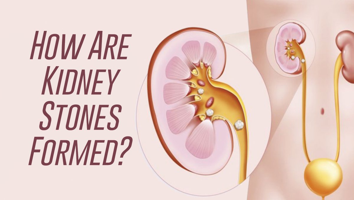 How Are Kidney Stones Formed?