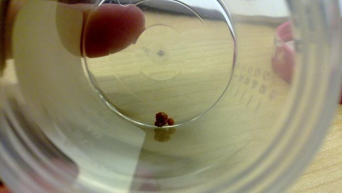 How Big Is a 7 Millimeter Kidney Stone?