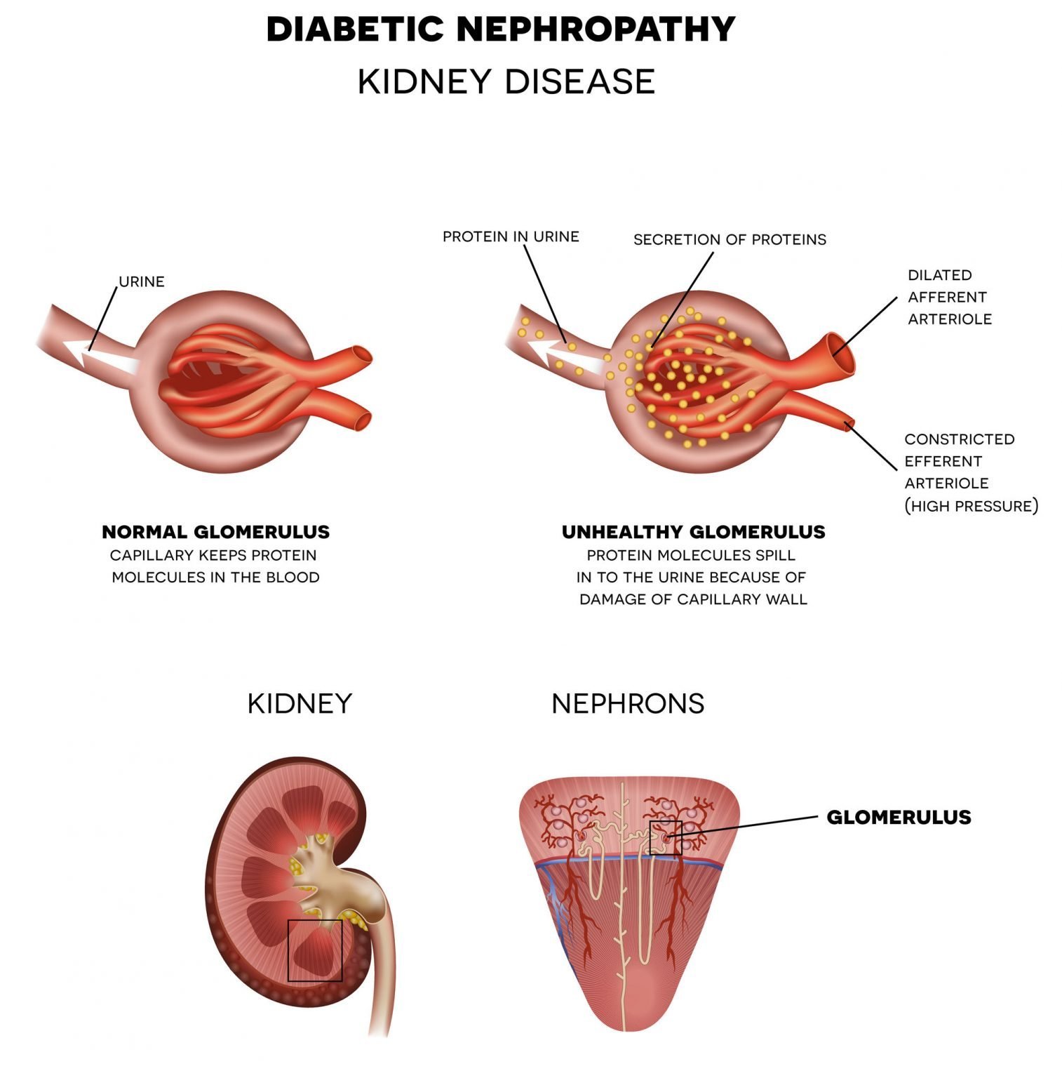 How Diabetes Affects Your Kidneys? Causes, Symptoms, Treatment