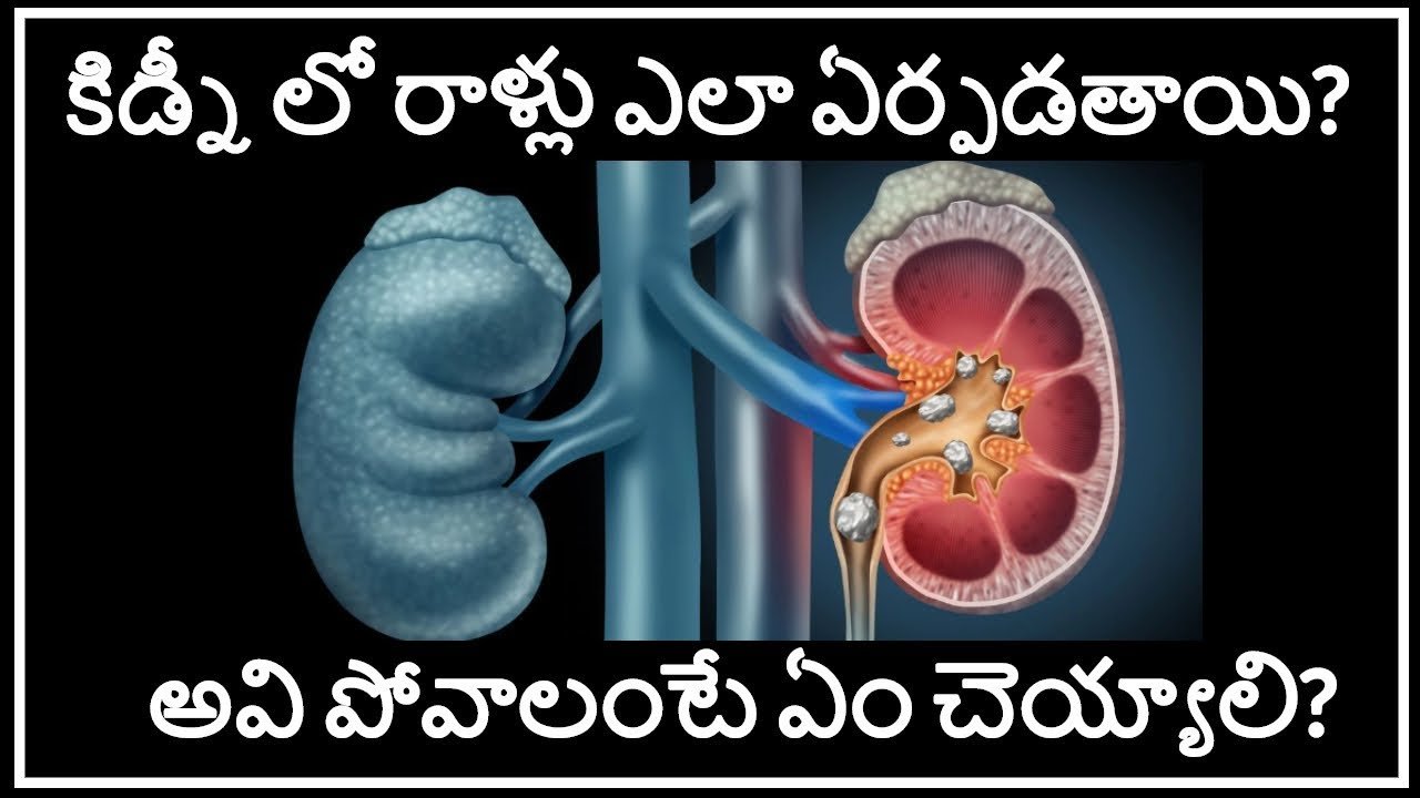 How Do Kidney Stones Form in Telugu