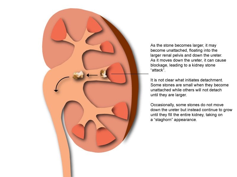 How do kidney stones form?