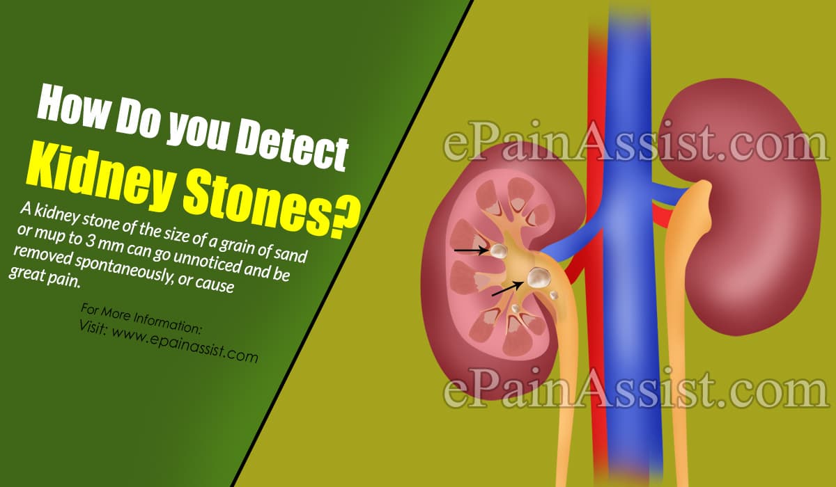 How Do you Detect Kidney Stones?