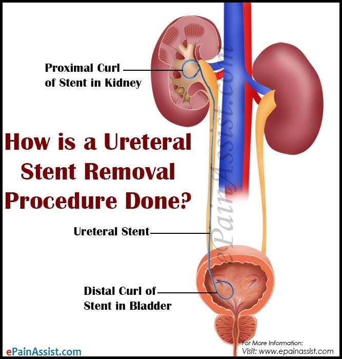How is a Ureteral Stent Removal Procedure Done?