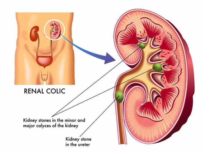 How long does it take to pass a kidney stone? How to do it ...