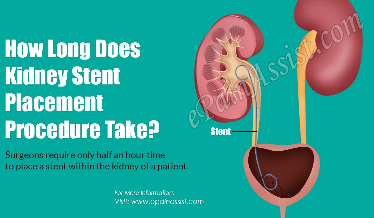 How Long Does Kidney Stent Placement Procedure Take?