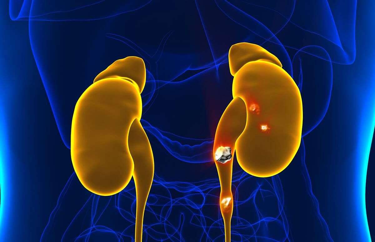 How to Cut Your Risk of Kidney Stones