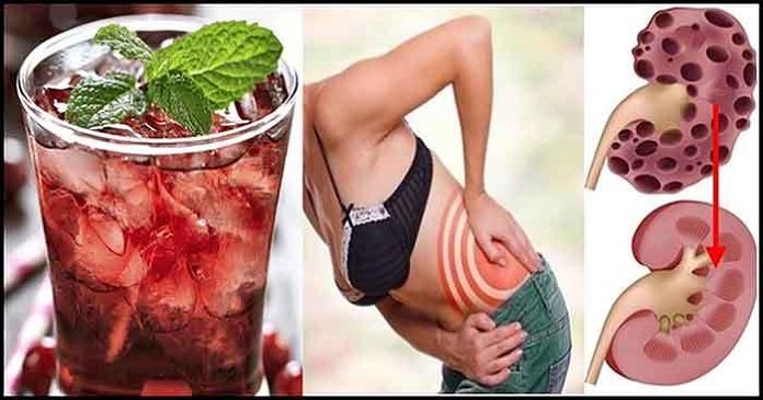 How To Detox Your Kidneys And Improves Itâs Functionality ...