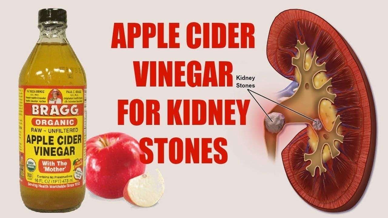 How To Dissolve Kidney Stones Free And Naturally At Home Just Using Appl...