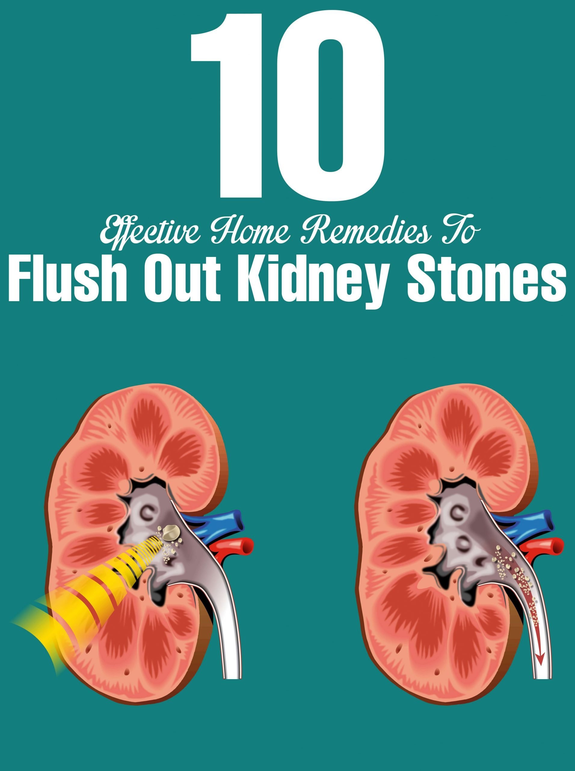 How To Dissolve Kidney Stones Naturally Without Surgery ...