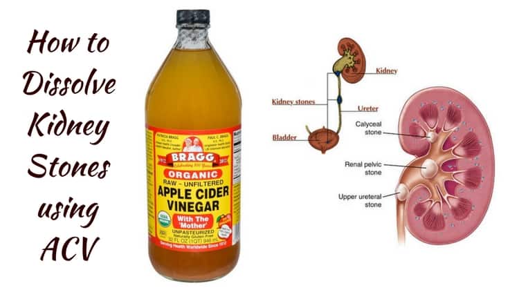 How to Dissolve Kidney Stones using Apple Cider Vinegar