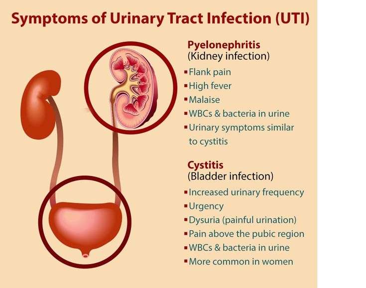 How to Get Rid of a UTI in 24 hours