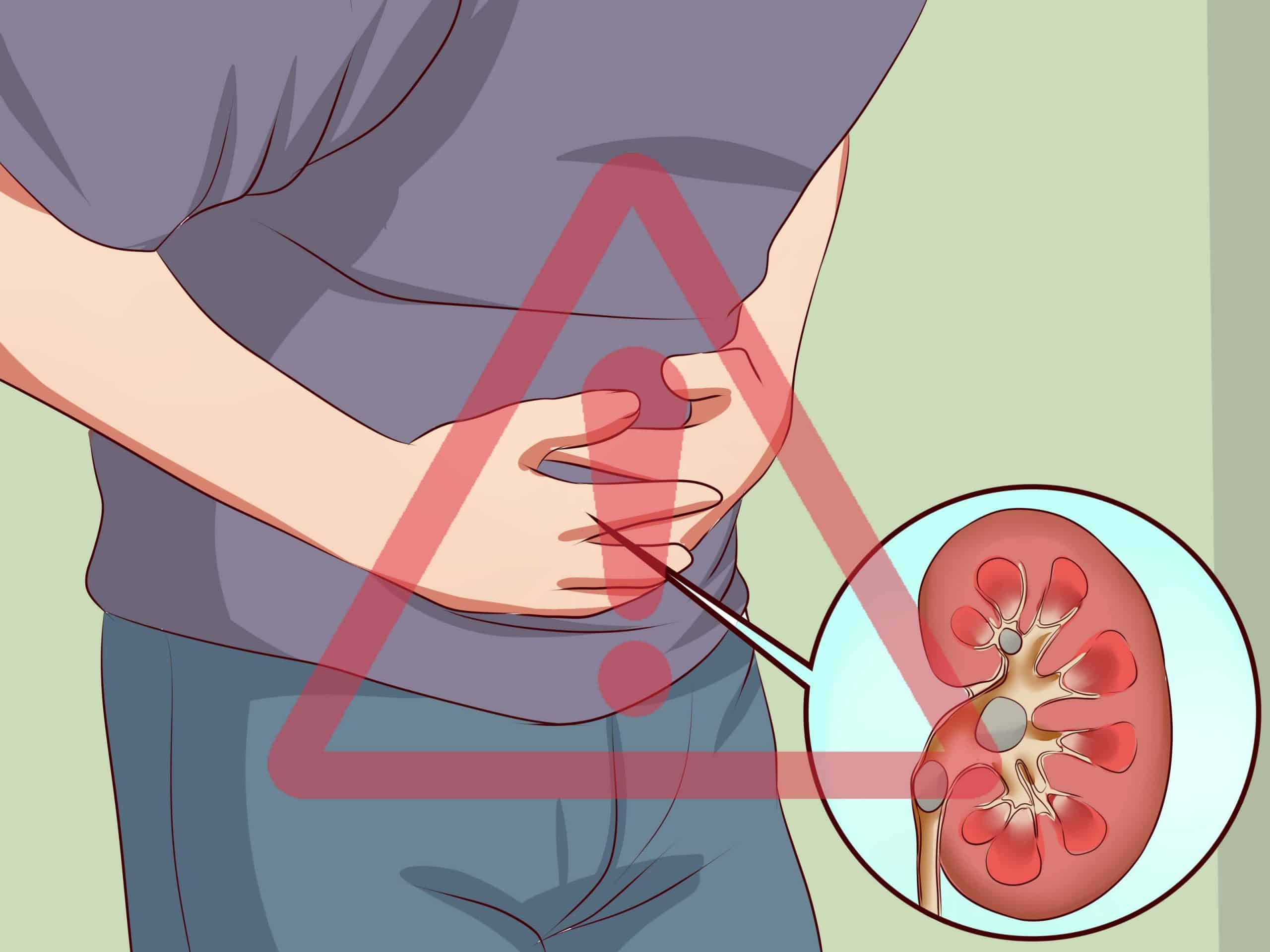 How to Get Rid of Kidney Stones: 12 Steps (with Pictures)