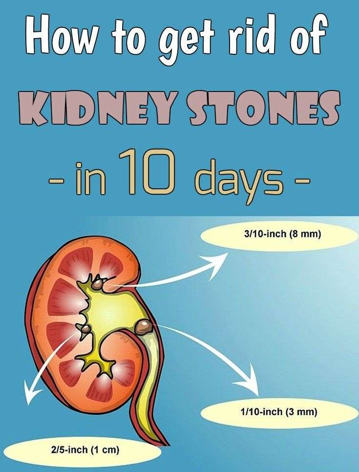 How to get rid of kidney stones in 10 days ...