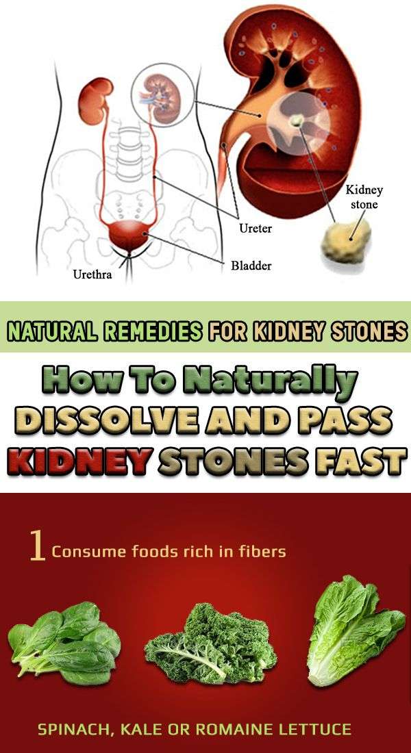 How To Get Rid Of Kidney Stones (With images)
