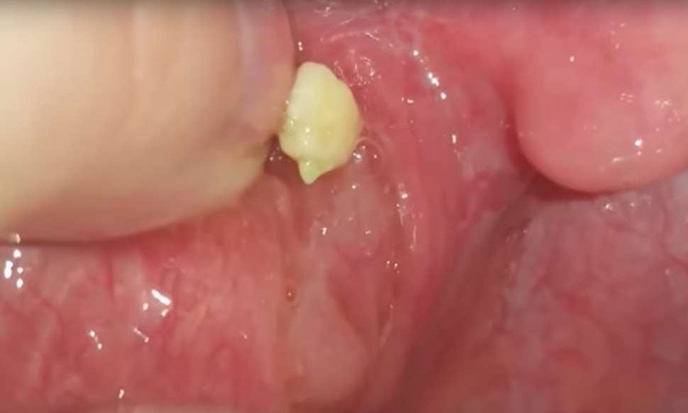 how to get rid of tonsil stones you can