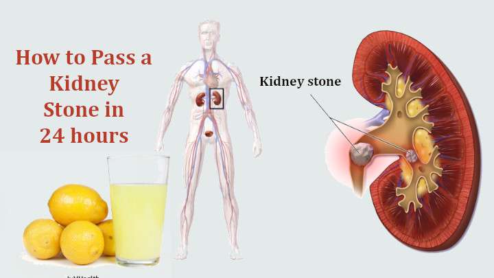 How to Pass a Kidney Stone in 24 hours (100% Working)