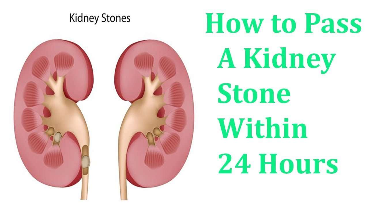 How to Pass A Kidney Stone Within 24 Hours