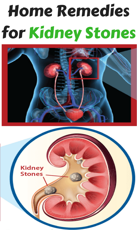 How To Pass Kidney Stones Fast at Home
