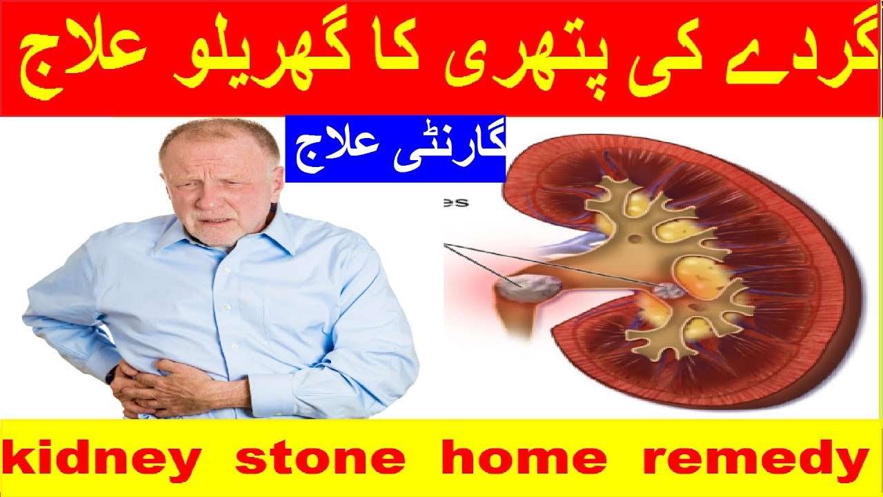 how to pass kidney stones fast