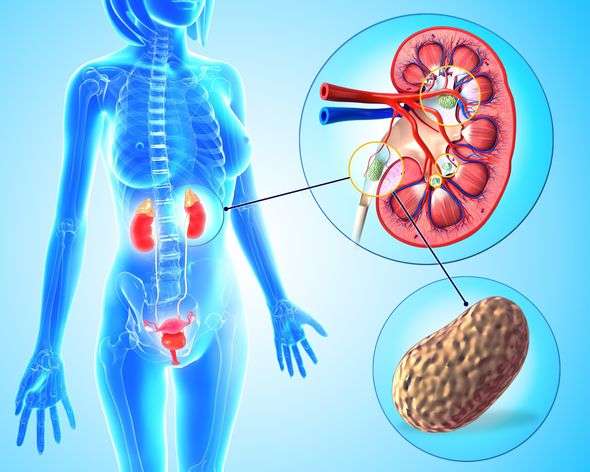 How to prevent kidney stones as hospital cases soar