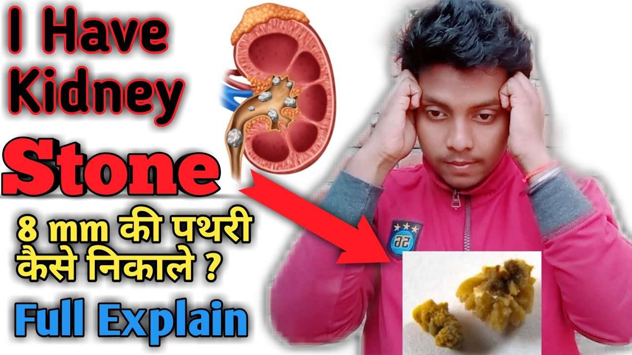 How To Remove Kidney stone I I have big stone I 8mm à¤ªà¤¤à¥?à¤¥à¤°à¥ à¤à¥à¤¸à¥ à¤¨à¤¿à¤à¤¾à¤²à¥ ...