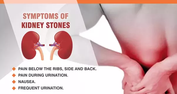 How to treat kidney stones