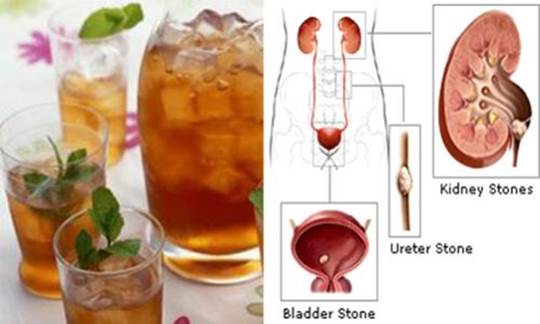 Ice Tea Causes Kidney Stones
