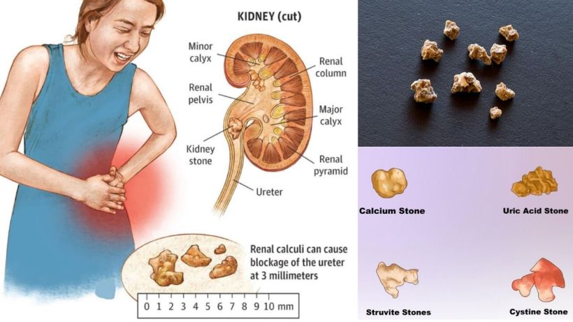 Identify Pain From Kidney Stones