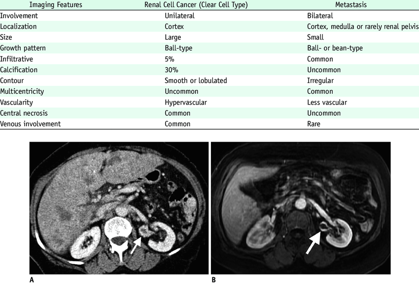 Imaging Features of Renal Cell Cancer and Metastasis in ...
