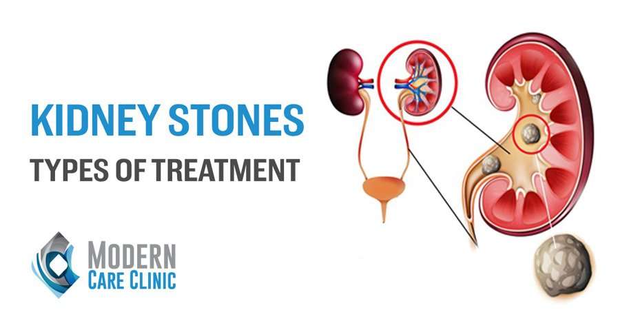 Impressive Info about Kidney Stones