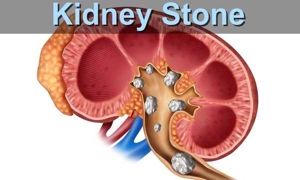 Is 10 mm kidney stone big?