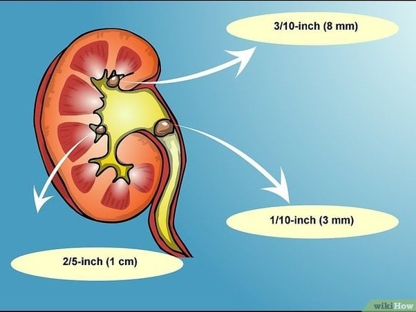 Is surgery required for a 5 mm kidney stone?