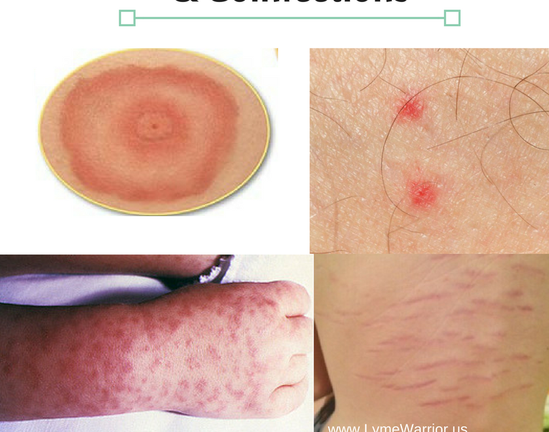 Itchy Kidney Disease Skin Rash Pictures