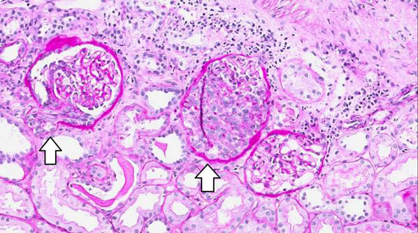 Kidney biopsy. Up to 45% of visible glomeruli reveal ...