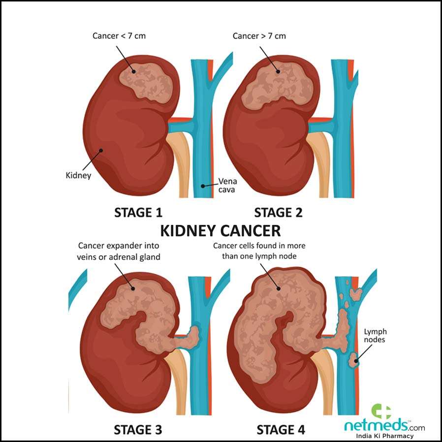 Kidney Cancer: Causes, Symptoms And Treatment