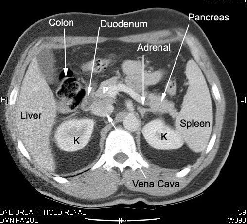 Kidney Cat Scan What To Expect