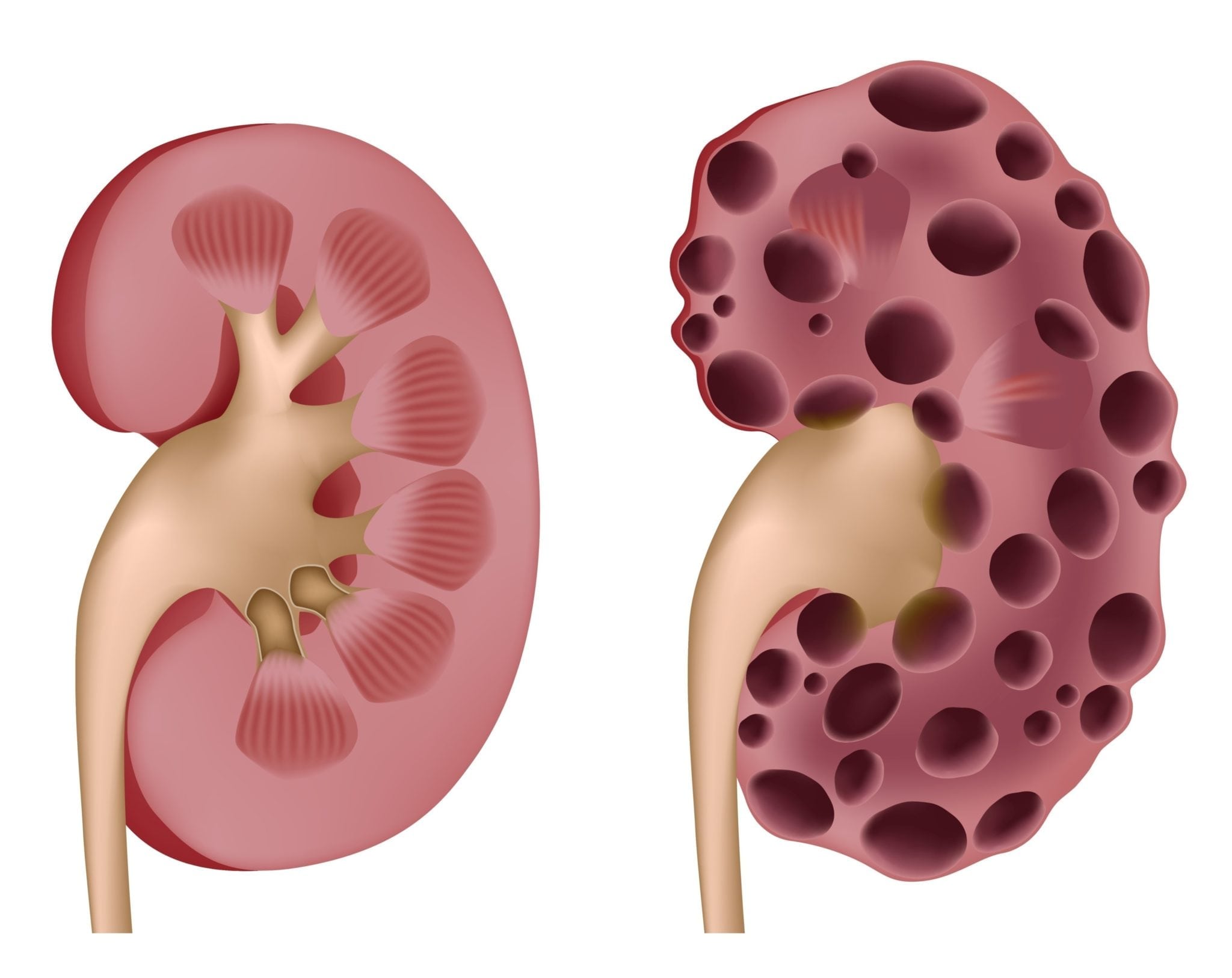 Kidney Cysts
