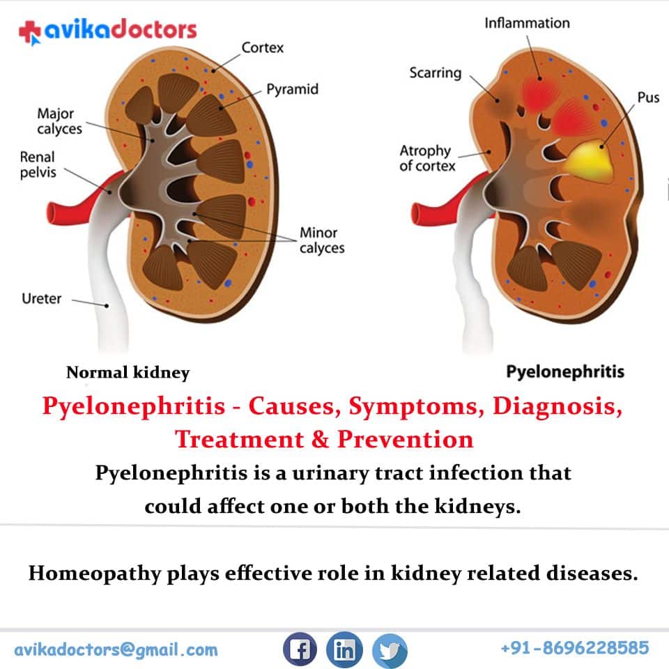 Kidney Cysts Homeopathic Treatment