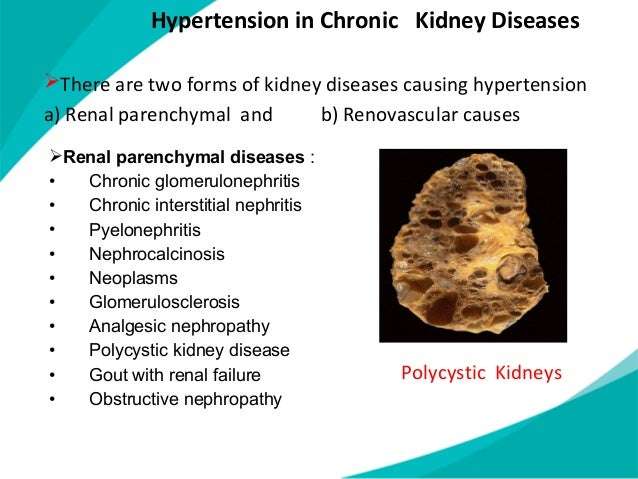 Kidney Disease Can Cause Hypertension By