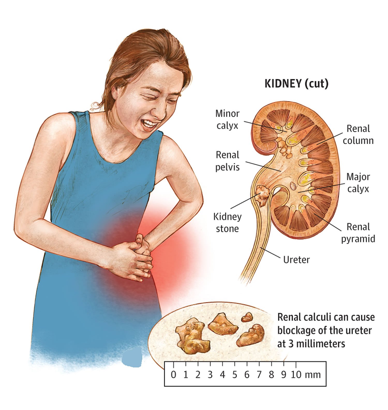 Kidney Stone, Causes, Prevention &  Natural Home Remedy ...