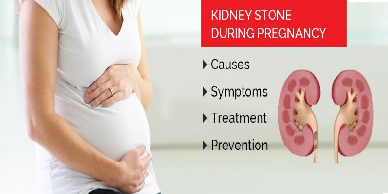 Kidney Stone during Pregnancy â Causes, Symptoms ...