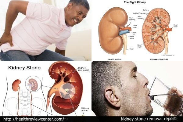 Kidney Stone Home Remedy