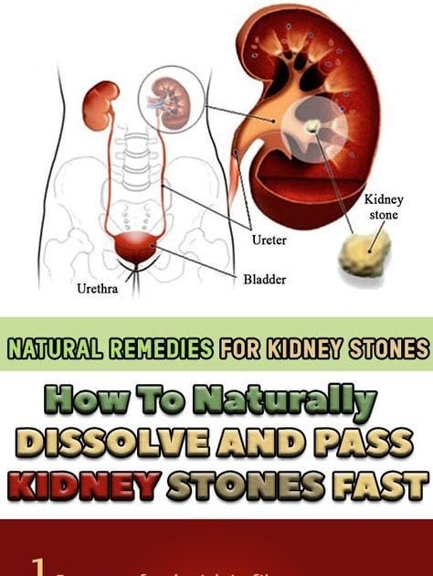 Kidney Stone How Large To Pass