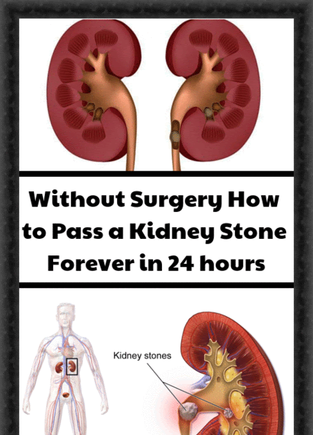Kidney Stone In Kidney How Long To Pass