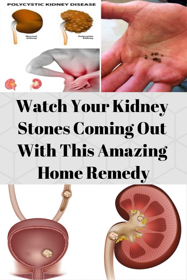 Kidney Stone Pain Comes And Goes For Weeks